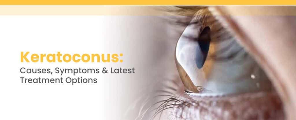Keratoconus: Causes, Symptoms & Latest Treatment Options