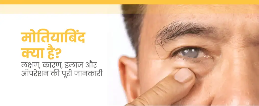 मोतियाबिंद क्या है? लक्षण, कारण, इलाज और ऑपरेशन की पूरी जानकारी