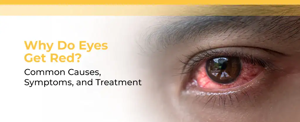 Why Do Eyes Get Red? Common Causes, Symptoms, and Treatment